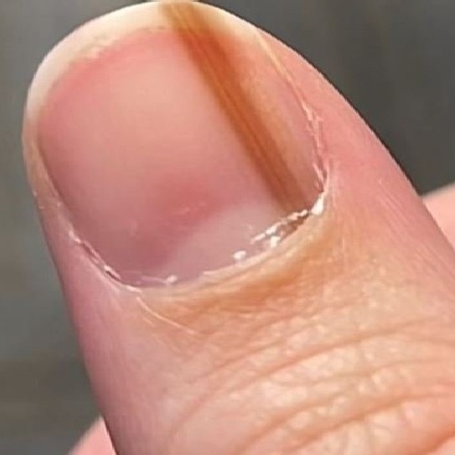 melanoma na unha tem cura