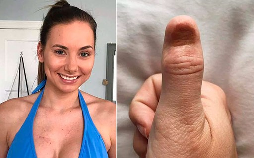 5 ideias de títulos:
1. Melanoma de Unha: Sinais de Alerta que Você Não Pode Ignorar
2. Entendendo o Melanoma Subungueal: Diagnóstico e Diferenciação
3. Grupos de Risco para Melanoma de Unha: Quem Deve Ter Mais Atenção?
4. A Importância do Diagnóstico Precoce do Melanoma Ungueal
5. Melanoma de Unha vs. Micoses e Hematomas: Como Distinguir?