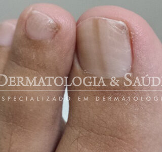 5 ideias de títulos:
1. Melanoma de Unha: Sinais de Alerta que Você Não Pode Ignorar
2. Entendendo o Melanoma Subungueal: Diagnóstico e Diferenciação
3. Grupos de Risco para Melanoma de Unha: Quem Deve Ter Mais Atenção?
4. A Importância do Diagnóstico Precoce do Melanoma Ungueal
5. Melanoma de Unha vs. Micoses e Hematomas: Como Distinguir?