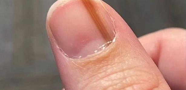 5 ideias de títulos:
1. Melanoma de Unha: Sinais de Alerta que Você Não Pode Ignorar
2. Entendendo o Melanoma Subungueal: Diagnóstico e Diferenciação
3. Grupos de Risco para Melanoma de Unha: Quem Deve Ter Mais Atenção?
4. A Importância do Diagnóstico Precoce do Melanoma Ungueal
5. Melanoma de Unha vs. Micoses e Hematomas: Como Distinguir?