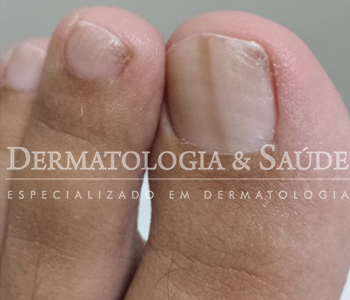 melanoma ungueal pé
