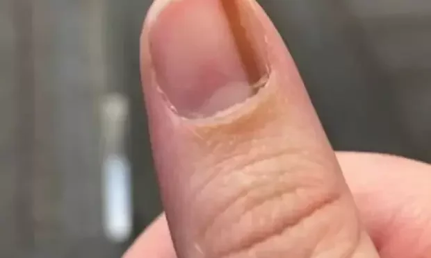 como identificar melanoma unha cedo