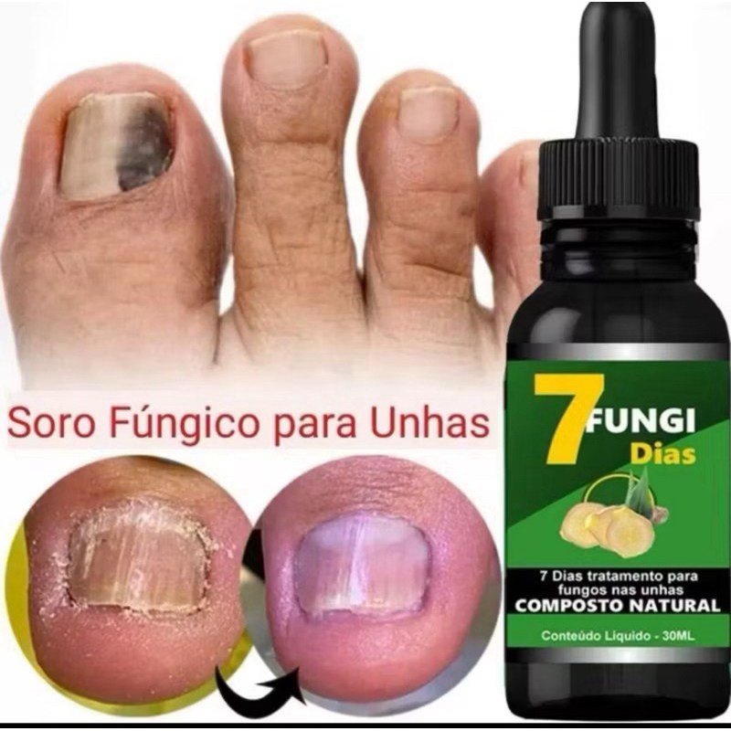 onicomicose tratamento