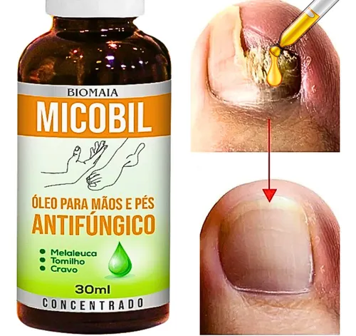 Tratamentos Caseiros para Micose de Unha: Mitos e Verdades