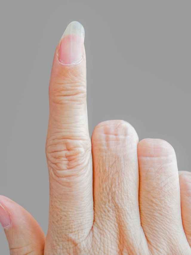 condições genéticas unhas