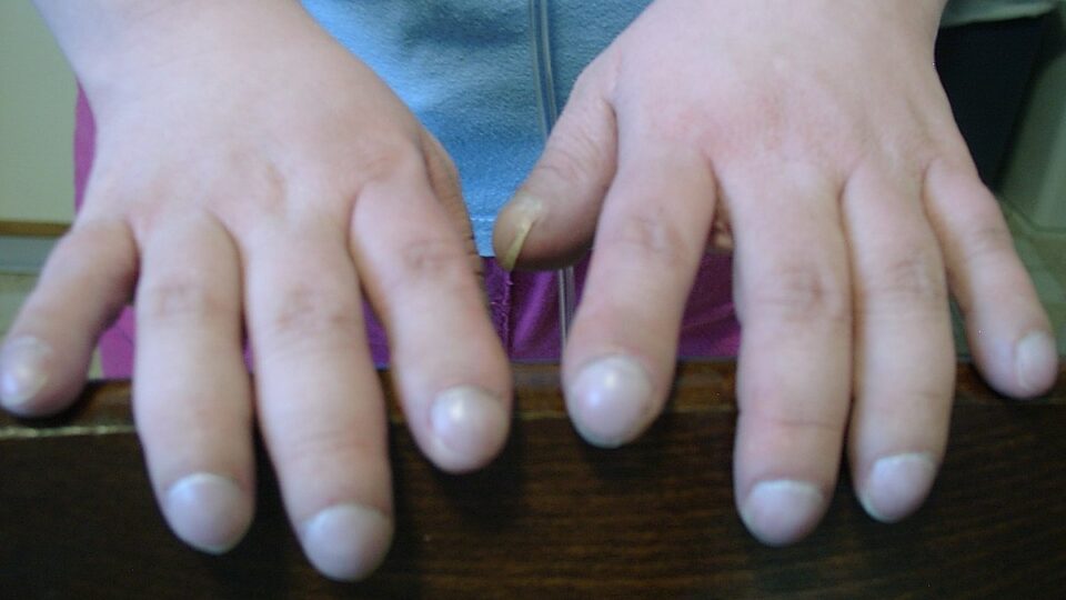 pessoa com unha minúscula