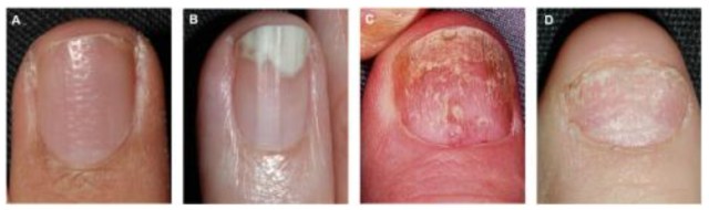 erros comuns ao fazer exame micológico de unha