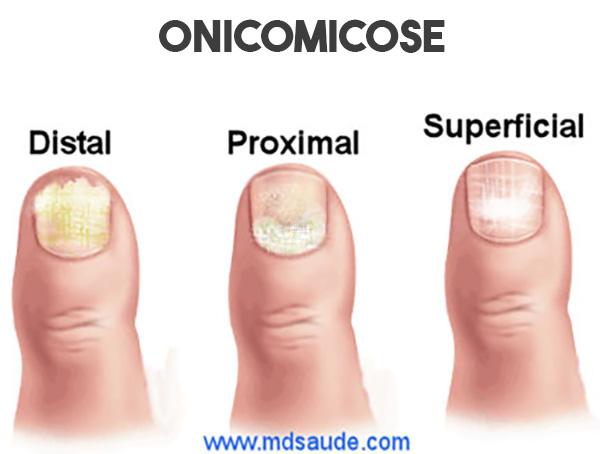 Os Melhores Esmaltes Antifúngicos para Tratar Onicomicose