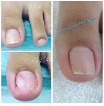 esmalte antifungico vs remedio oral para micose de unha