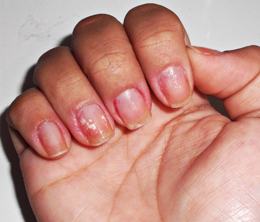 5 ideias de títulos:
1. Micose de Unha na Mão: Guia Completo de Sintomas e Tratamentos
2. Onicomicose Manual: Como Identificar