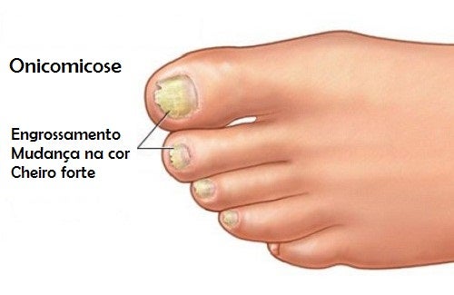 tratamento para micose de unha