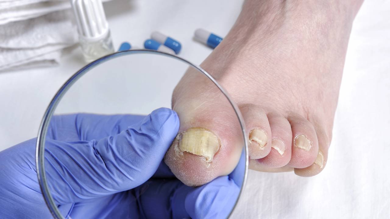 5 ideias de títulos:
1. Vinagre de Maçã: O Aliado Natural Contra a Micose de Unha
2. Guia Completo: Como Usar Vinagre para Tratar Micose de Unha em Casa
3. Micose de Unha: Receitas Caseiras com Vinagre que Realmente Funcionam
4. Dicas Essenciais para Potencializar o Tratamento Caseiro da Micose de Unha
5. Quando Procurar um Médico: Sinais de que a Micose de Unha Precisa de Atenção Profissional