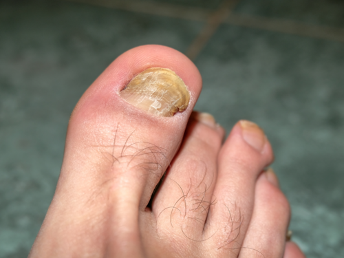 Tratamentos Caseiros para Micose de Unha: O que Funciona e o que Evitar