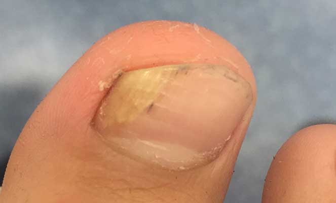 Vinagre de Maçã para Micose de Unha: Funciona Mesmo?