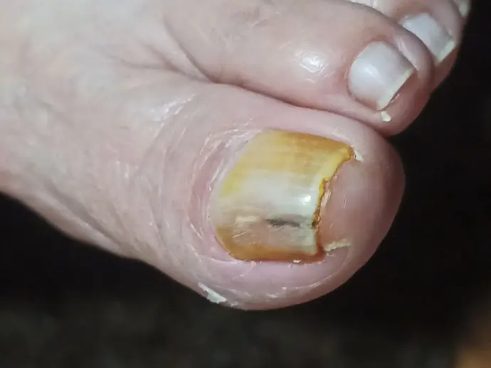 Medicamentos Orais para Micose de Unha: Prós e Contras