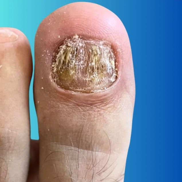 Diferença entre Loceryl e Lakesia: Qual Escolher para Sua Micose?