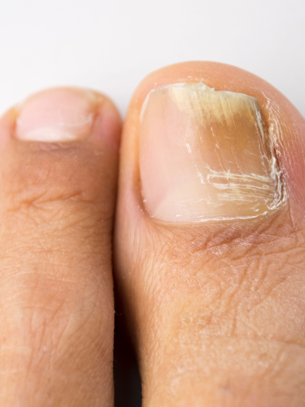 micose na unha do pé