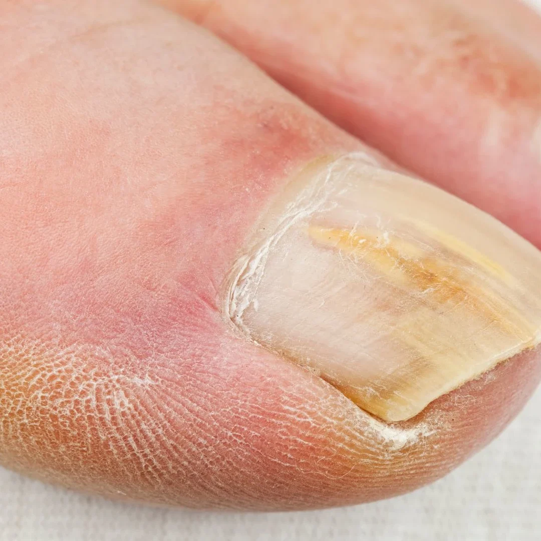 Os Melhores Esmaltes Antifúngicos para Onicomicose