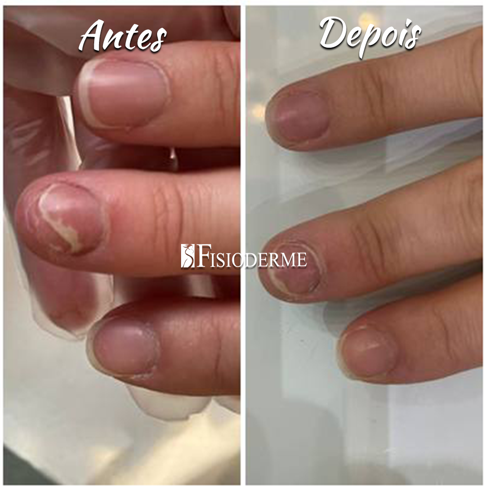 remédio oral ou tópico para micose de unha