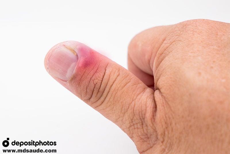o que nao fazer quando a unha esta inflamada