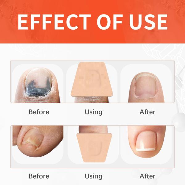 Os 5 melhores tratamentos para micose de unha: Guia completo