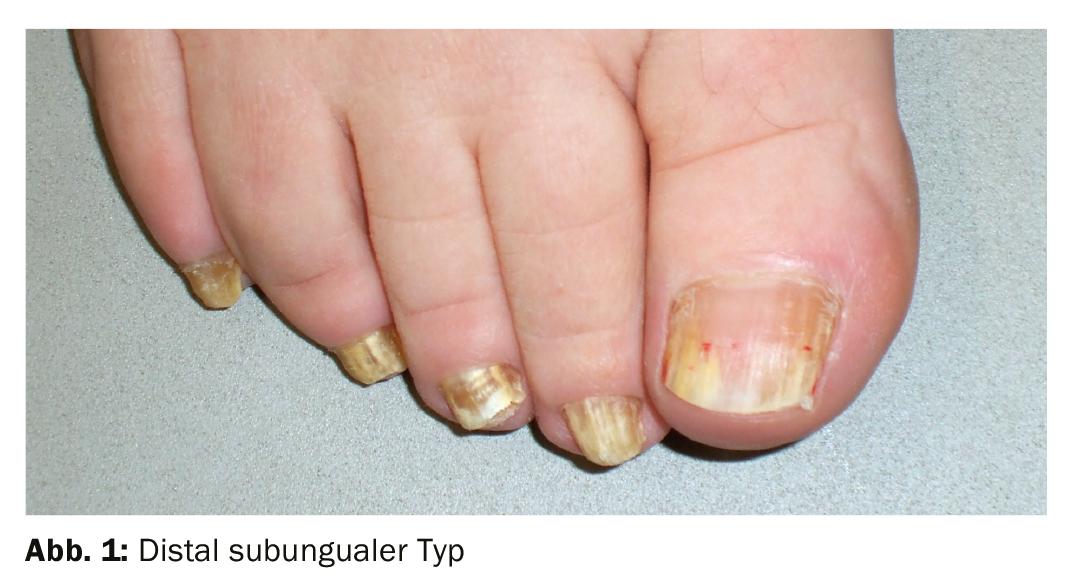 Medicamentos para micose de unha: Opções tópicas e orais