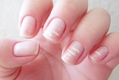 Alergias comuns relacionadas a cosméticos para unhas: como identificar e evitar