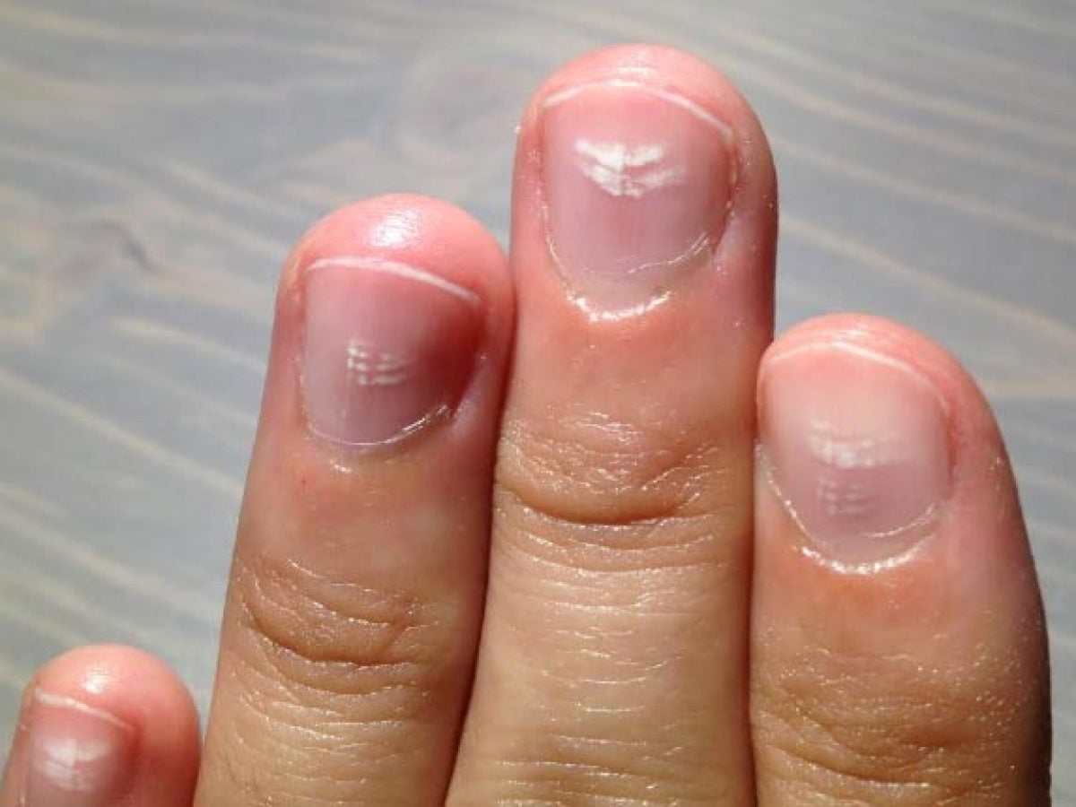 Como diferenciar micose de unha de outras condições?