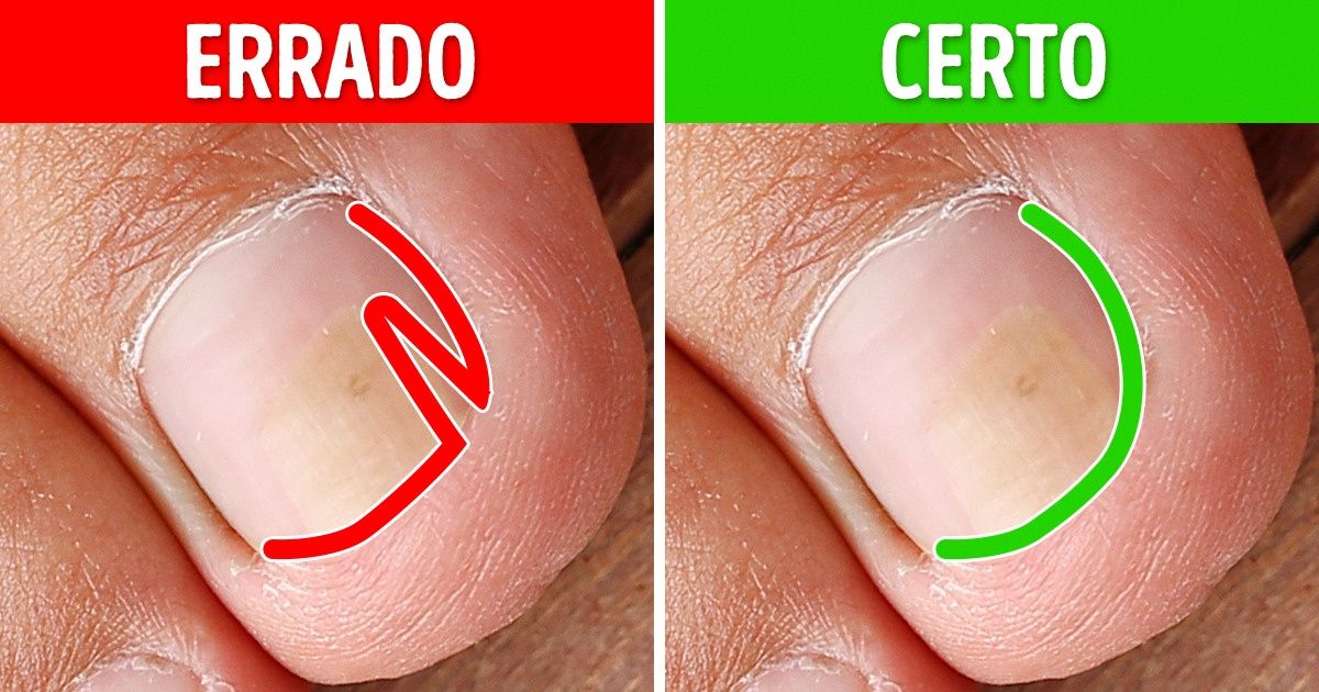 unha encravada dermatologista