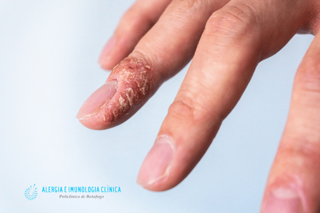 o que causa alergia unha de gel