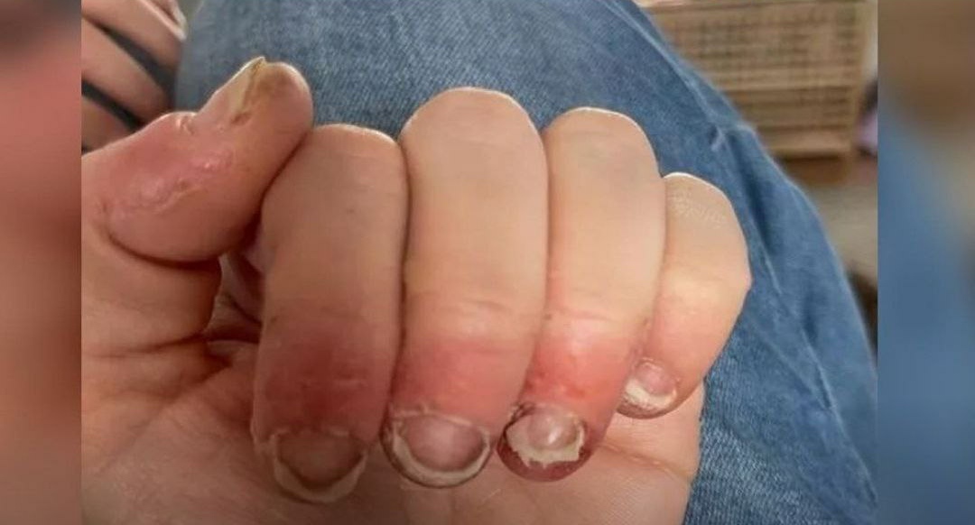 unha de gel pode dar alergia