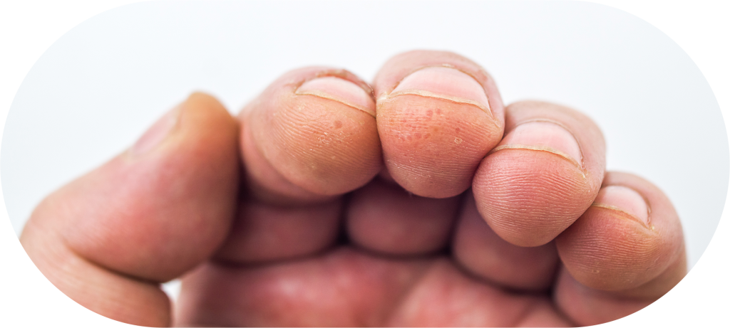 prevenir alergia unha de gel