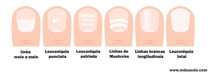 manchas brancas na unha e alergia
