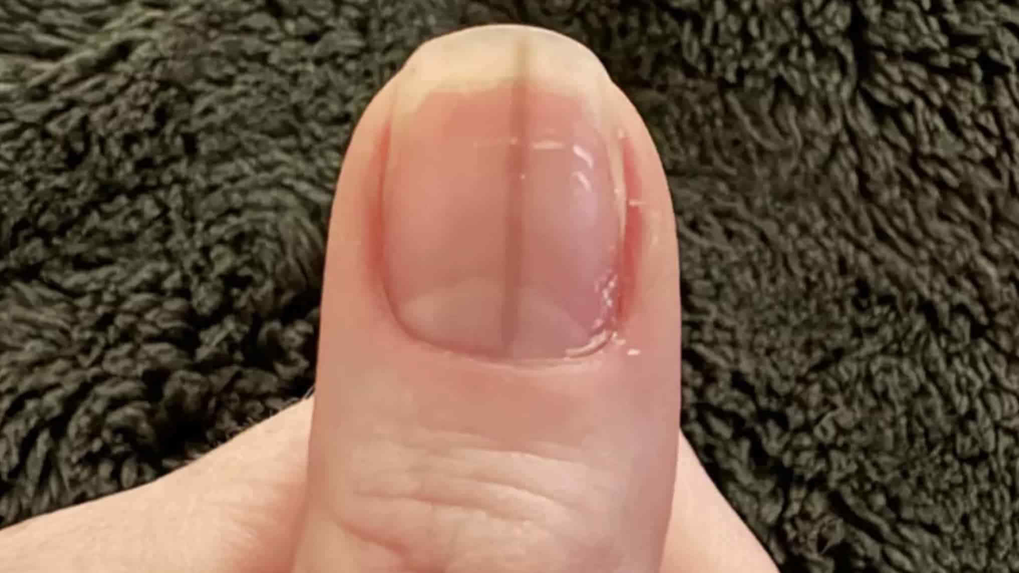 Traumas e Medicamentos: Impacto na Coloração das Unhas