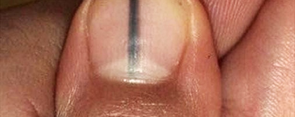 Traumas e Medicamentos: Impacto na Coloração das Unhas