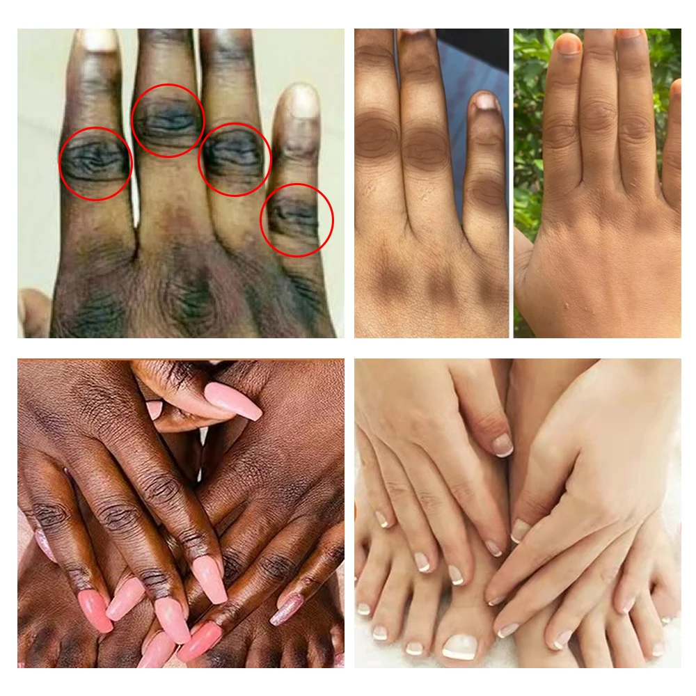 o que significa uma linha preta na unha do dedão