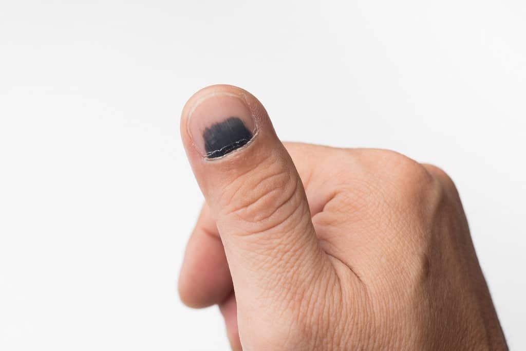 Como o Dermatologista Diagnostica Linhas Escuras nas Unhas?