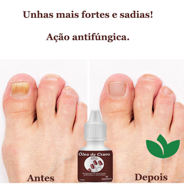 óleo de cravo e vitamina E para unhas