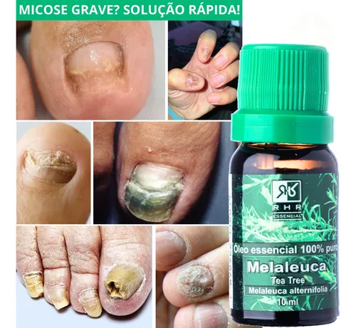oleo de melaleuca na unha