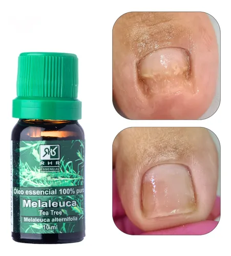 5 ideias de títulos
1. Óleo de Melaleuca: O Guia Completo para Unhas Saudáveis
2. Adeus Micose: Como o Óleo de Melaleuca Transforma Suas Unhas
3. Unhas Fortes e Regeneradas: Descubra o Poder do Tea Tree Oil
4. Guia Prático: Aplicação Correta do Óleo de Melaleuca nas Unhas
5. Onde Comprar Óleo de Melaleuca para Tratamento de Unhas: Melhores Opções