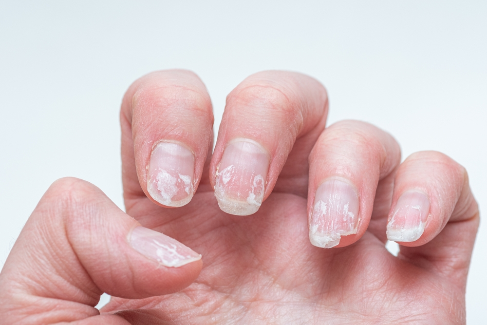 unhas quebradiças e onduladas