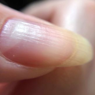 unhas com estrias