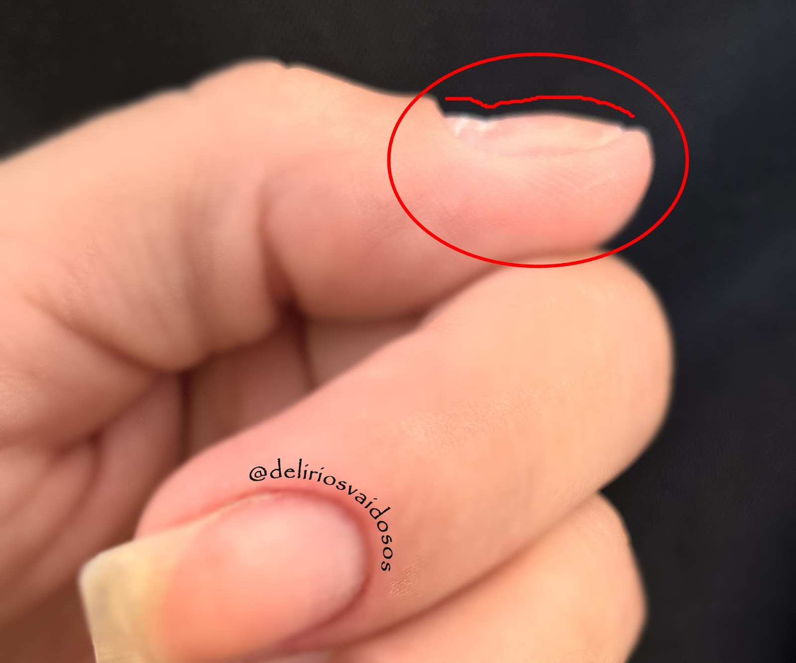 causas de unhas onduladas
