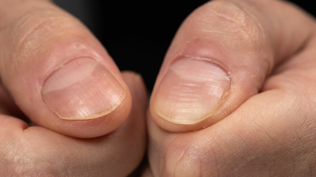 unhas onduladas e envelhecimento
