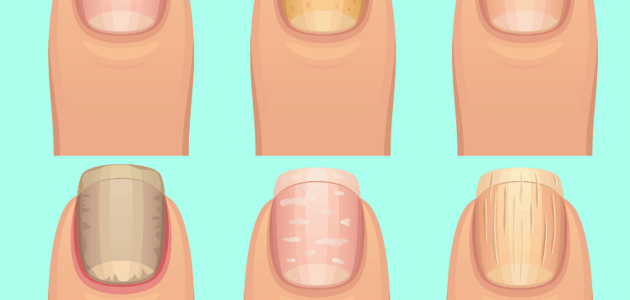 unhas onduladas e deficiência de vitaminas
