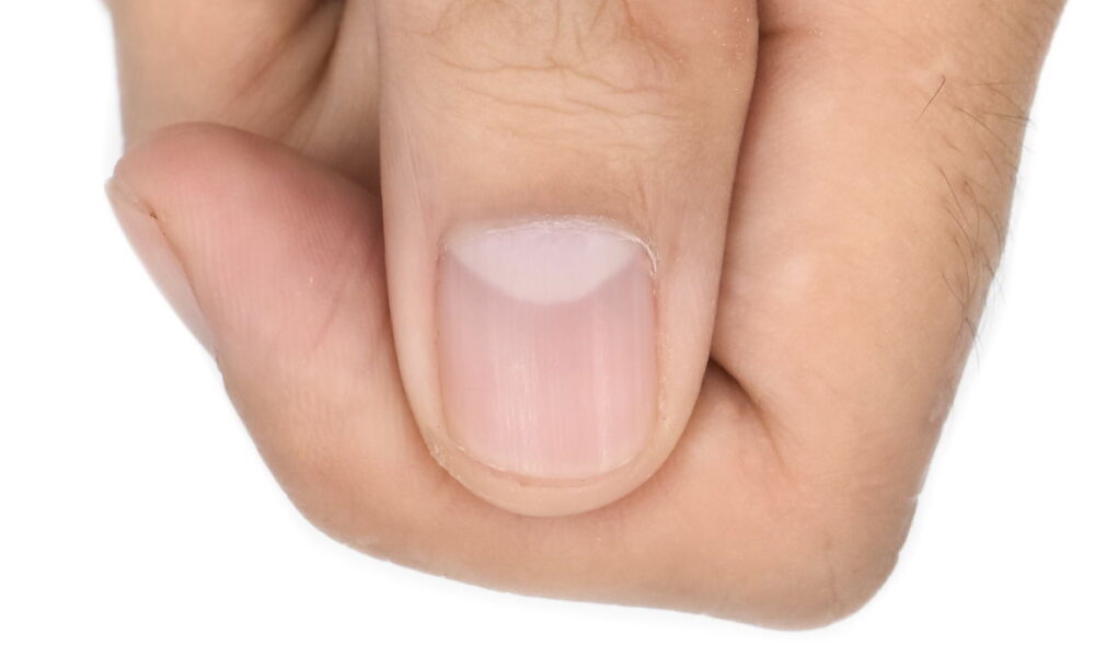 unhas onduladas e psoríase