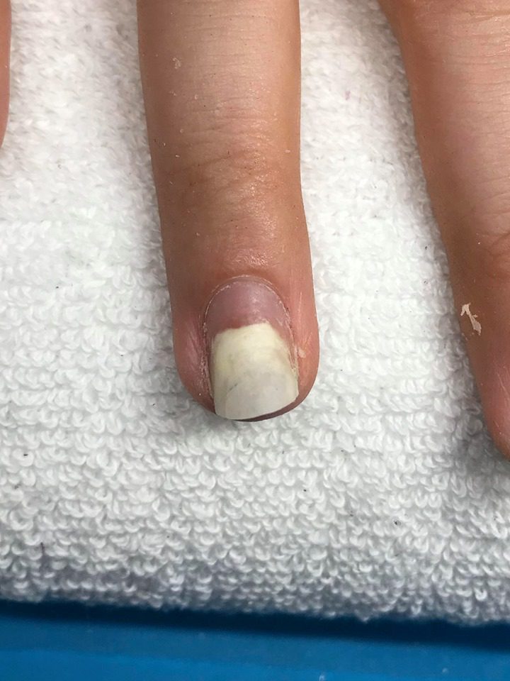 onicólise o que não fazer para piorar