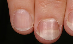 onicólise vs micose como diferenciar