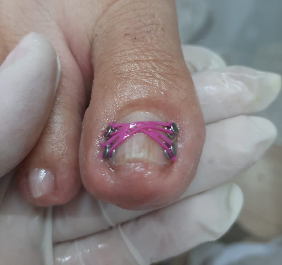 5 ideias de títulos:
1. Órtese para Unha Encravada: Guia Completo de Tratamento e Tipos
2. Como a Onicoórtese Corrige Unhas Tortas e Alivia a Dor
3. Fibra de Memória Molecular vs. Órtese Metálica: Qual a Melhor para Você?
4. Onde Encontrar e Quanto Custa o Tratamento com Órtese Ungueal?
5. Podologia Descomplicada: Entenda o Papel da Órtese na Saúde das Unhas