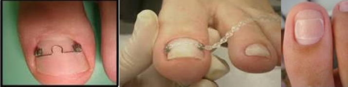 5 ideias de títulos:
1. Órtese para Unha Encravada: Guia Completo de Tratamento e Tipos
2. Como a Onicoórtese Corrige Unhas Tortas e Alivia a Dor
3. Fibra de Memória Molecular vs. Órtese Metálica: Qual a Melhor para Você?
4. Onde Encontrar e Quanto Custa o Tratamento com Órtese Ungueal?
5. Podologia Descomplicada: Entenda o Papel da Órtese na Saúde das Unhas